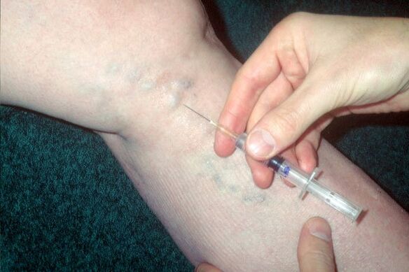 склеротерапия за разширени вени