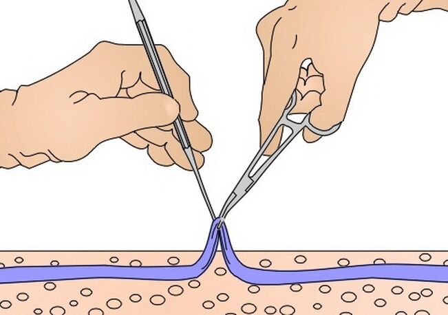 отстраняване на вени при разширени вени