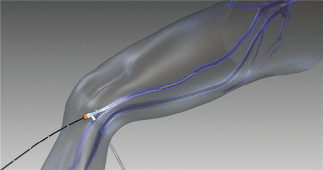 радиочестотна облитерация на разширени вени